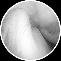 ACL Reconstruction