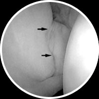 Hip Arthroscopy