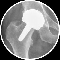Hip Resurfacing