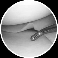 Knee Arthroscopy
